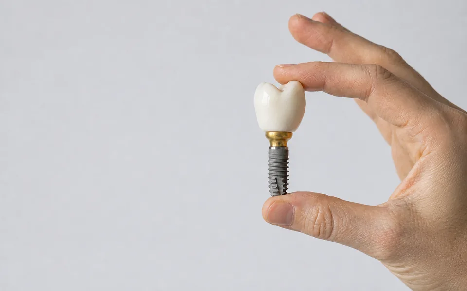 A dental implant assembled in full: the titanium screw, the abutment and the crown